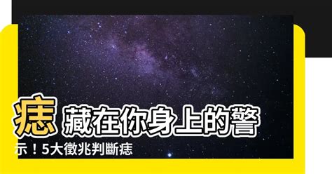 身體痣的好壞|快檢查身體！痣長這裡致死率超高 醫曝5大判斷標準｜ 